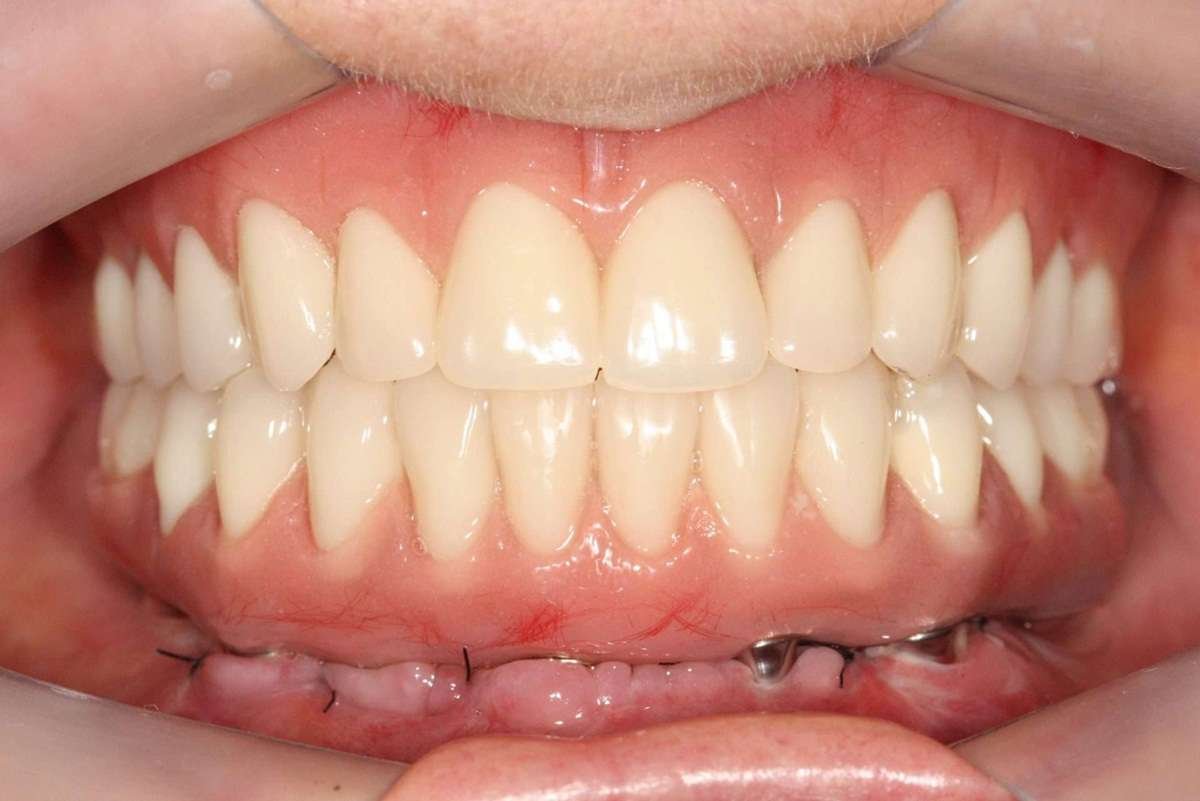 Paciente sorrindo com implantes de carga imediata - Antes e Depois